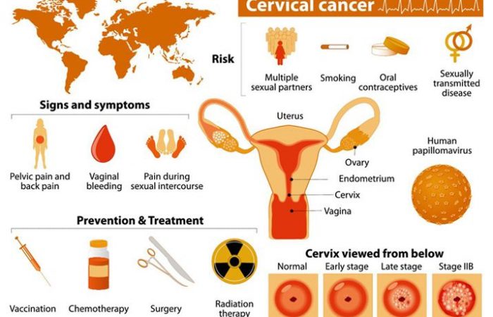 Cervical Cancer: A Forgotten Tragedy
